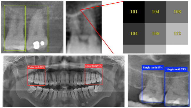 DPR dental X-ray images sampled using the YOLO algorithm